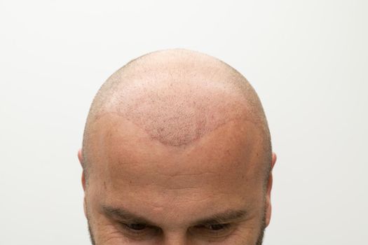 closeup portrait of bald man after hair implantation therapy