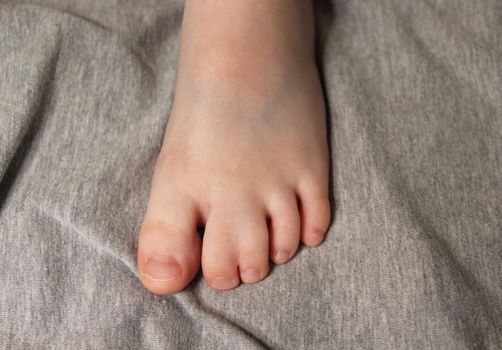 Hereditary disease. Syndactyly. Child's foot with disease close up.