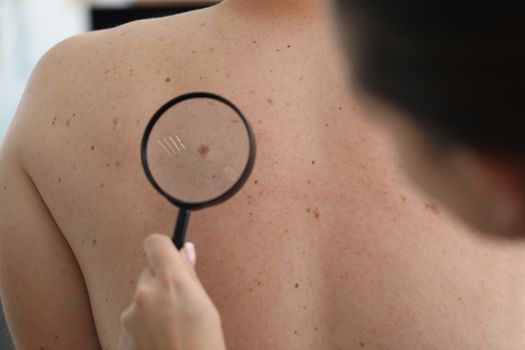 Close-up of dermatologist doctor examines birthmark of patient on back with magnifying glass. Client checks mole in clinic. Diagnostic, medicine concept