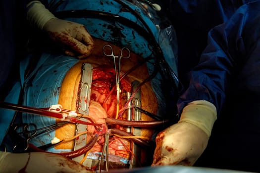 Open heart surgery with different surgical tubes connected to a coronary artery bypass heart close up