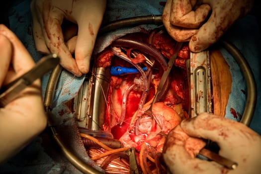 Close up of implantation of a biological heart valve cardiovascular surgery team open heart surgery
