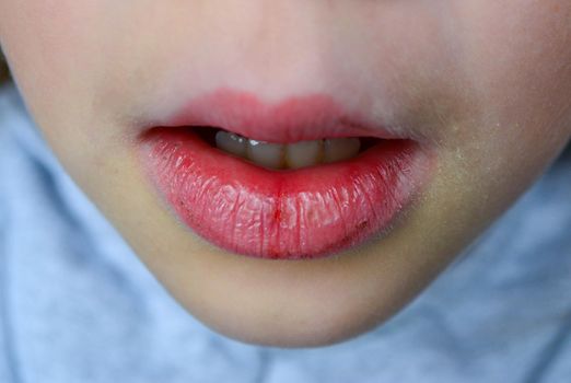 Dry and damaged lips of a girl. Close-up. Lip fissure and bleeding. Sick cracked damaged tissue. Dry lips with cracks, dry mouth, Closeup face with brittle and dry lips, dehydration High quality photo