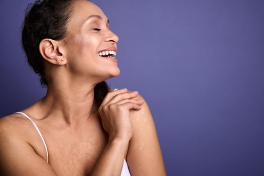 Closeup beauty portrait - confident delightful woman with vitiligo, dermatological skin problems, smiling, hugging herself, against purple background with copy space. Body positivity, self-acceptance
