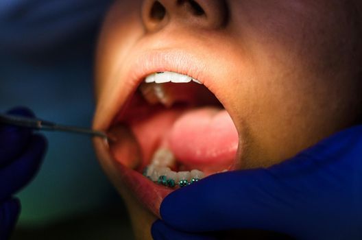 Dentist examining a patients teeth in the dentists chair under bright light at the dental clinic