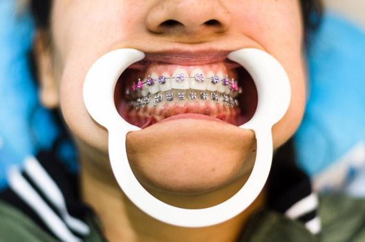 Closeup of young woman's teeth with braces and retractor for mouth. Patient at the dentist