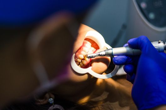 Dentist doing a dental treatment on a female patient