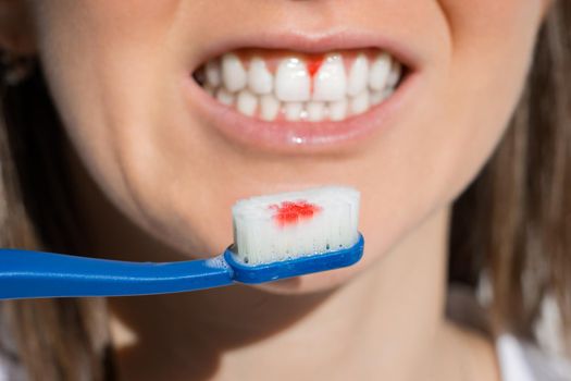 Close up of woman mouth with bleeding gums during teeth brushing. Periodontal disease, avitaminosis, gingivitis, scurvy. High quality photo