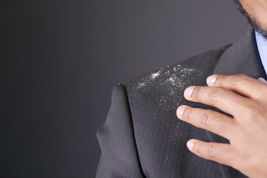 men with dandruff i on his coat .