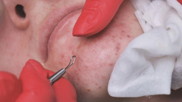 Squeezing acne from a girl with problem skin in the salon using a loop