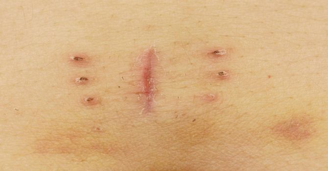 Close-up macro of a scar with bruise near navel as result of hysterectomy, butterfly shape