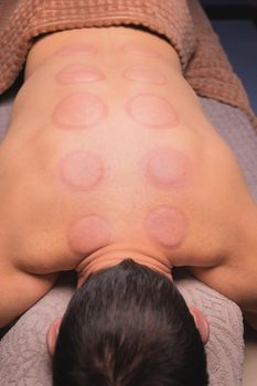 Man after cupping therapy on his back. Skin after cupping in traditional Chinese medicine. man returned from hijama cups in acupuncture therapy. Chinese traditional treatment
