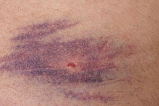Detailed view of big bruise over caucasian skin leg