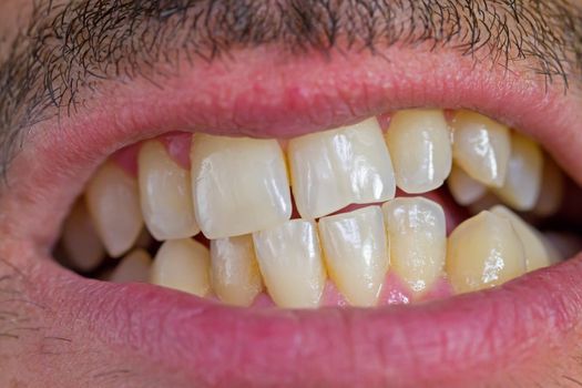 caucasian man mouth and irregular teeth closeup