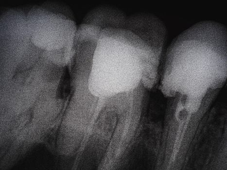 dental x-ray of several bad molars. caries. Horizontal orientation