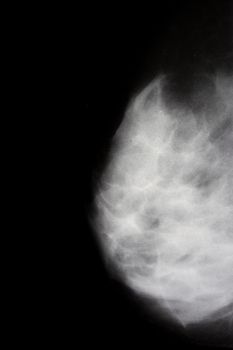 woman right breast xray closeup, vertical composition