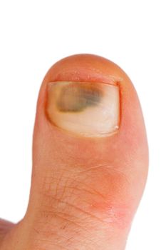 closeup of caucasian woman big toe with bruise over toenail