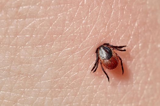 Sucking tick Macro photo on human skin. Ixodes ricinus. Bloated parasite bitten into pink irritated epidermis. Small red drops. Dangerous insect mite. Encephalitis, Lyme disease infection.