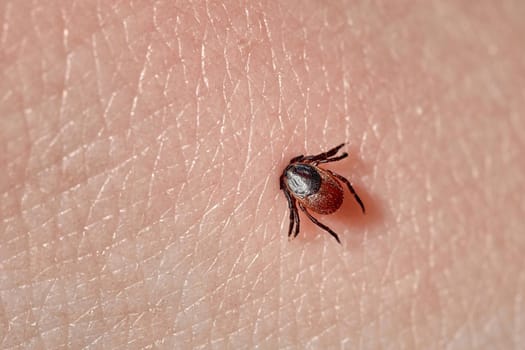 Sucking tick Macro photo on human skin. Ixodes ricinus. Bloated parasite bitten into pink irritated epidermis. Small red drops. Dangerous insect mite. Encephalitis, Lyme disease infection.