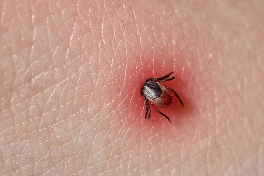 Sucking tick Macro photo on human skin. Ixodes ricinus. Bloated parasite bitten into pink irritated epidermis. Small red drops. Dangerous insect mite. Encephalitis, Lyme disease infection.