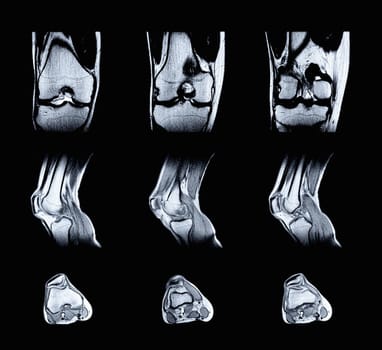 Magnetic resonance imaging (MRI) of right knee. Closed injury of the knee joint, with manifestations of arthrosis.