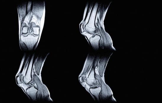 Magnetic resonance imaging (MRI) of right knee. Closed injury of the knee joint, with manifestations of arthrosis.