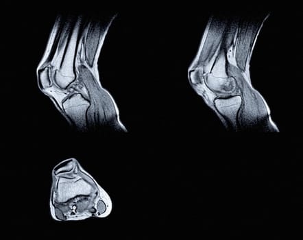 Magnetic resonance imaging (MRI) of right knee. Closed injury of the knee joint, with manifestations of arthrosis.