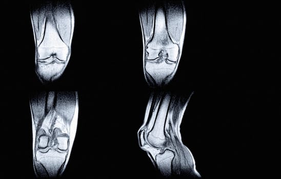 Magnetic resonance imaging (MRI) of right knee. Closed injury of the knee joint, with manifestations of arthrosis.