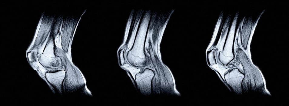 Magnetic resonance imaging (MRI) of right knee. Closed injury of the knee joint, with manifestations of arthrosis.