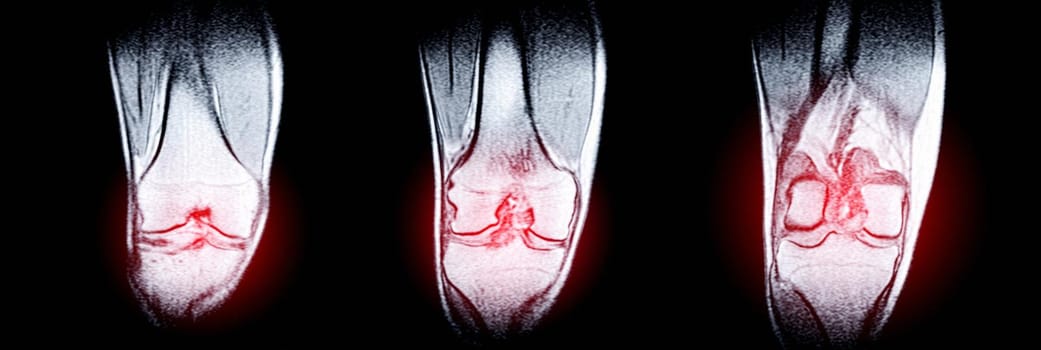 Magnetic resonance imaging (MRI) of right knee. Closed injury of the knee joint, with manifestations of arthrosis. A crunch in the knee joint.