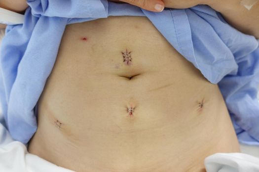 Woman myoma case after myomectomy by laparoscopy with dressing and suture stitches in the hospital