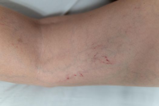 removal of blood vessels by laser dermatology leg health up, cutout anatomy. Swelling dermis, up telangiectases physical