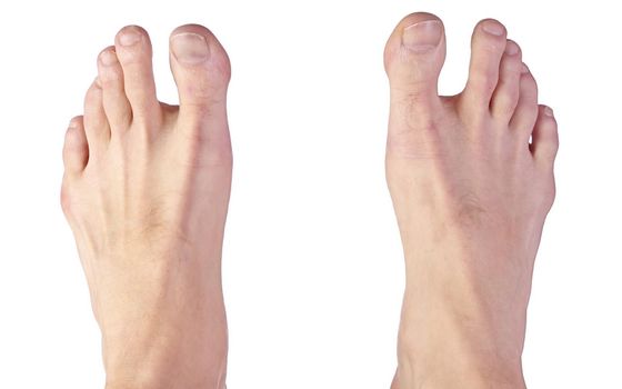 Close up of a Man's Feet Showing Sandal Gap Deformity, also known as Hallux Varus Isolated on a White Background. High quality photo