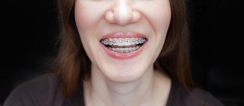 The smile of a young and beautiful girl with braces on her white teeth. Straightening of crooked teeth with the help of a bracket system. Malocclusion. Dental care. Smooth teeth and a beautiful smile