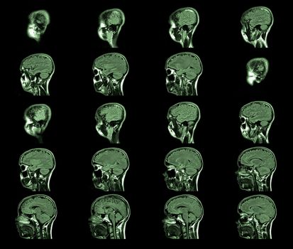 magnetic resonance imaging, MRI MRT head