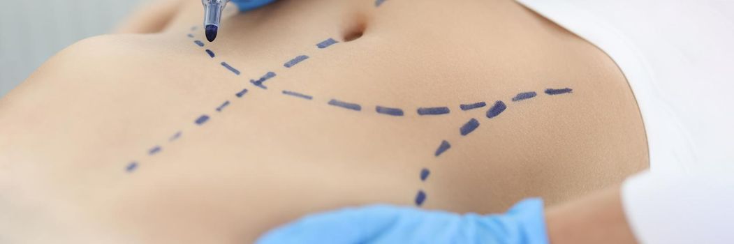 Doctor plastic surgeon drawing preoperative markings on skin of patient abdomen closeup. Plastic surgery and aesthetic medicine liposuction concept