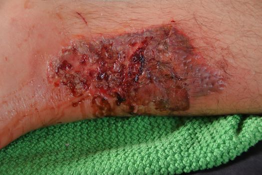 A third-degree burn on the leg of a Caucasian male against black background