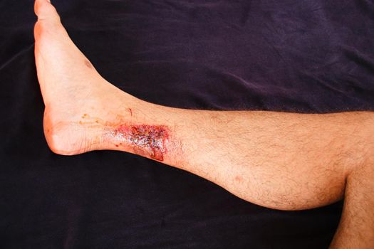 Partial thickness or third-degree burn on the leg of a Caucasian male against black background
