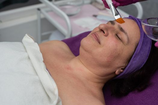 Peeling with acids. A beautician uses a brush to apply acid to the face to exfoliate dead skin