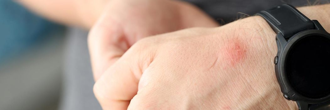 Closeup of red spot on skin of man hand. Insect bite treatment concept