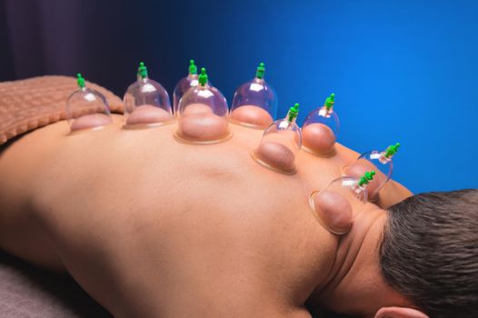 Cup massage in general. Vacuum jars for back massage for a man. Massage with vacuum cups. Cupping treatments for back pain relief. Caucasian man lies face down with mounted vacuum cups on his back.