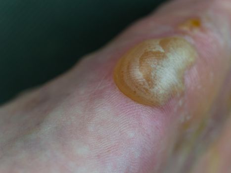 Big blister and flaking skin on foot from Pompholyx eczema