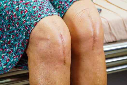 Asian elderly woman patient with scar knee replacement surgery in hospital.