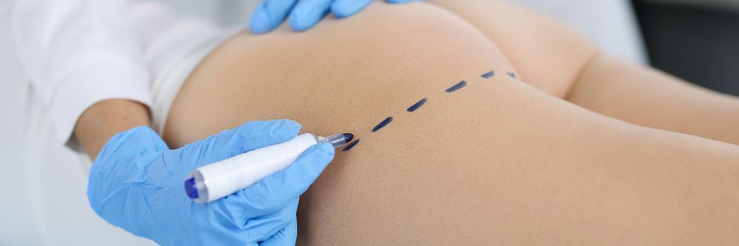 Doctor draws marks on the patient's buttocks with marker for body shaping. Buttocks plastic concept