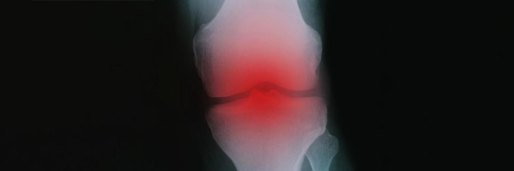 X ray with red inflammation of knee joint closeup. Diagnosis and treatment of arthritis concept