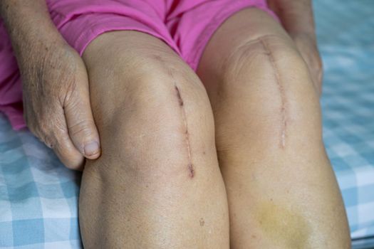 Asian senior or elderly old lady woman patient show her scars surgical total knee joint replacement Suture wound surgery arthroplasty on bed in nursing hospital ward, healthy strong medical concept.