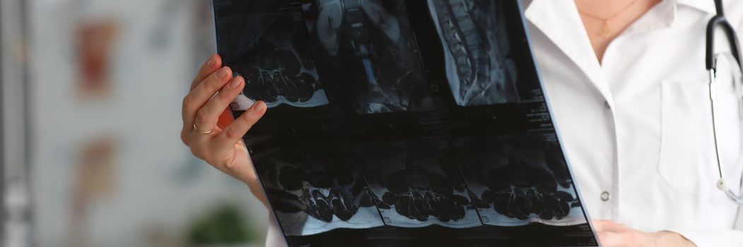 Young woman doctor is holding x-ray of person spine. Lumbar vertebrae displacement concept