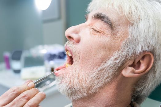 Elderly male at the stomatologist. Person with yellow teeth.