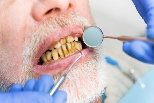 Mouth mirror and bad teeth. Close up of dental examination.