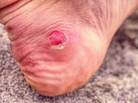 Naked foot with painful Heel wound in nature. Man feet caused by new shoes. Cracked terrible blister on human heel with . 