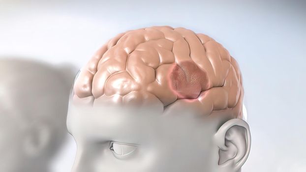 A brain tumor is a collection or mass of abnormal cells in your brain. 3D illustration